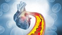 Zvýšená hladina cholesterolu v krvi ukazuje, že trpíte poruchou látkové výměny tuků neboli dyslipidemií