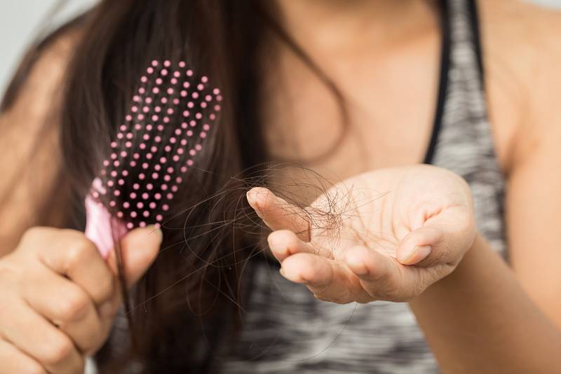 Alopecie. Nemoc se zpočátku projevuje vypadáváním vlasů na hlavě nebo ztrátou vousů.