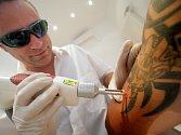 Laserové odstraňování tetování. Ilustrační foto.