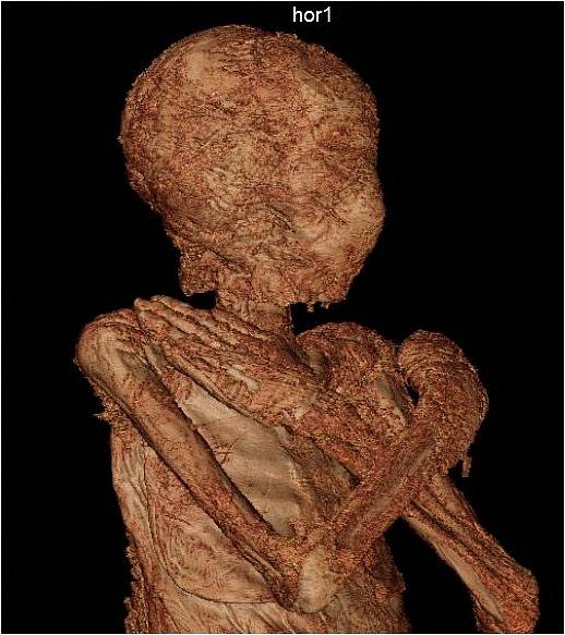 Rentgenový snímek mumie přezdívaná Záhadná dáma. V době smrti byla egyptská žena těhotná.