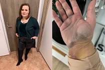 Základem léčby lipedému jsou liposukční metody. Hanka Čechová už absolvovala liposukci nohou i rukou. Na fotce je její hojící se ruka po operaci.