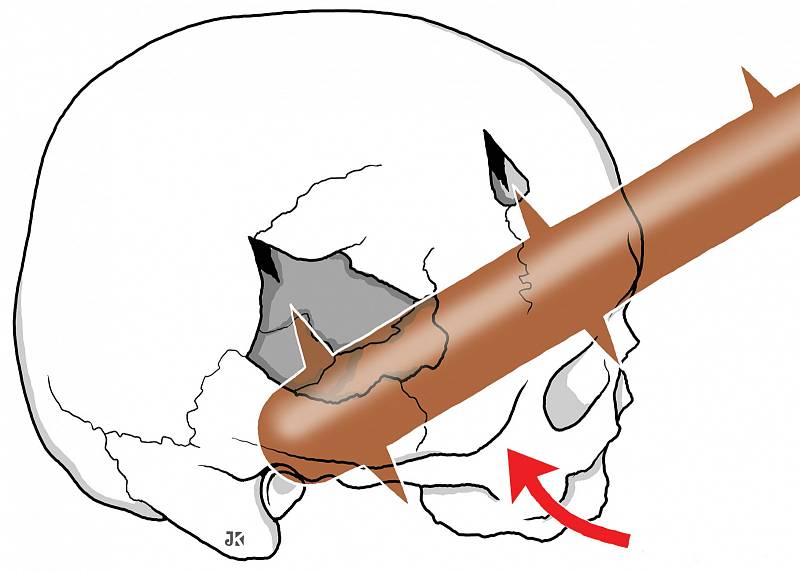 Kresebná rekonstrukce poranění lebky cepem od Jana Kacvinského z Anatomického ústavu 1. LF UK.