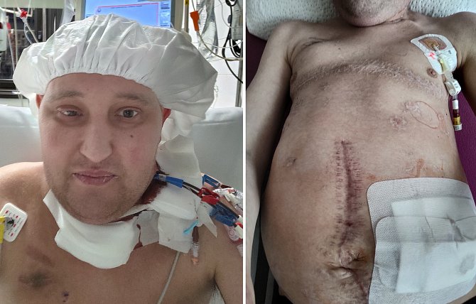 Jednatřicetiletý Tomáš Hois má za sebou čtyři transplantace
