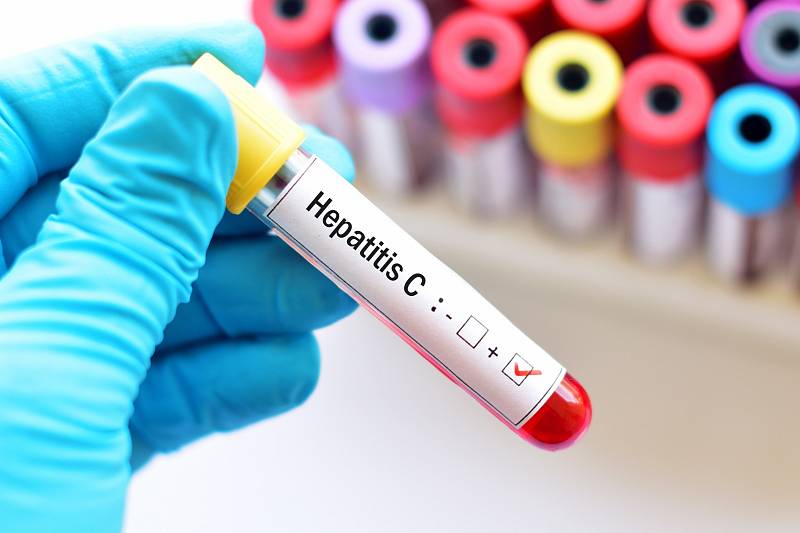 Léčba hepatitidy C je dostupná ve specializovaných centrech ČR.
