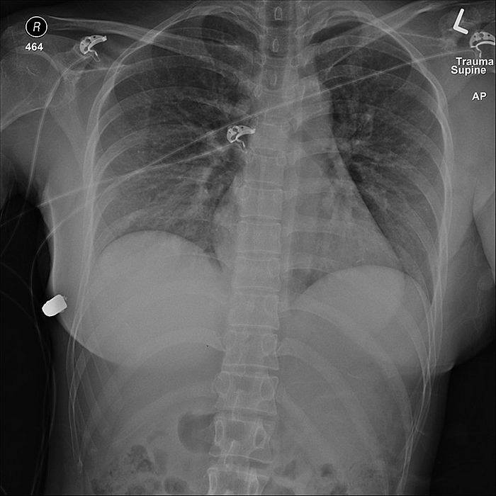 Rentgenový snímek hrudní dutiny ženy i s uvízlou střelou