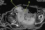 CT zkoumání plodu uvnitř těla mumie; A je hlava a B je ruka