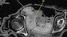 CT zkoumání plodu uvnitř těla mumie; A je hlava a B je ruka