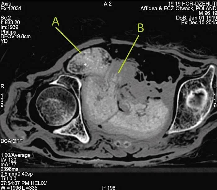 Zkoumání plodu uvnitř těla mumie za pomoci výpočetní tomografie; A je hlava a B je ruka