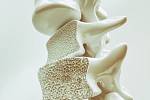 Řídnutí kostí vzniká nerovnováhou mezi přírůstkem a odbouráváním kostní tkáně. Už od 25 let věku ztrácíme asi půl procenta kostní hmoty ročně