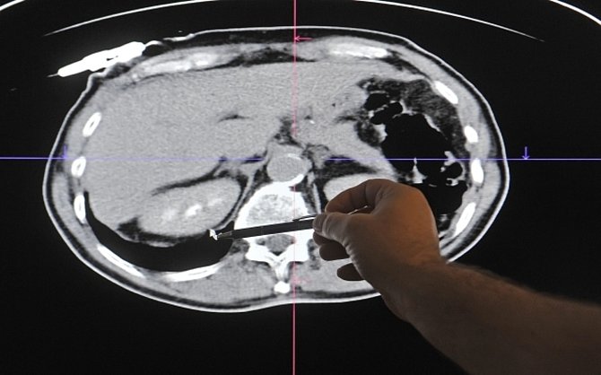 CT snímek ledvin - ilustrační foto.