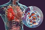 Pneumokok je jedním z nejčastějších původců zápalů plic a respiračních infekcí