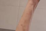Jedním z příznaků covidu bylo nepříjemné pálení kůže. Za několik dní se mně po celém těle objevily modřiny.