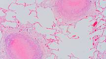 Mikroskopický snímek Pneumocystis jiroveci, houby objevené český parazitologem Otto Jírovcem