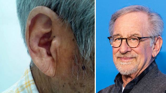 Typické rýhy na ušním lalůčku u jedince s anginou pectoris, tedy vážným onemocněním oběhové soustavy (na snímku vlevo). Tuto rýhu na uchu má i slavný režisér Steven Spielberg