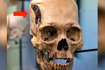 Starověká lebka z Peru s podivnou kovovou destičkou, vyhlížející jako implantát namísto kosti