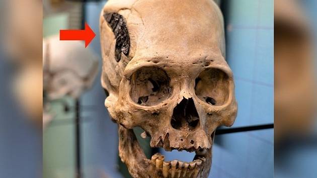 Starověká lebka z Peru s podivnou kovovou destičkou, vyhlížející jako implantát namísto kosti