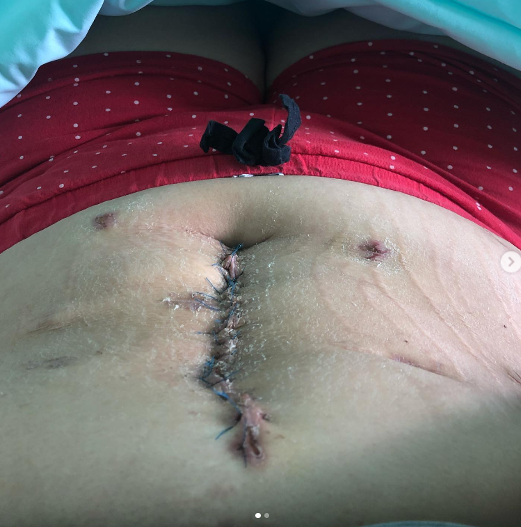 Po operacích zůstala Kláře jizva přes celé břicho