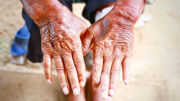 Projevy systematické sklerodermie začínají obvykle na prstech rukou.