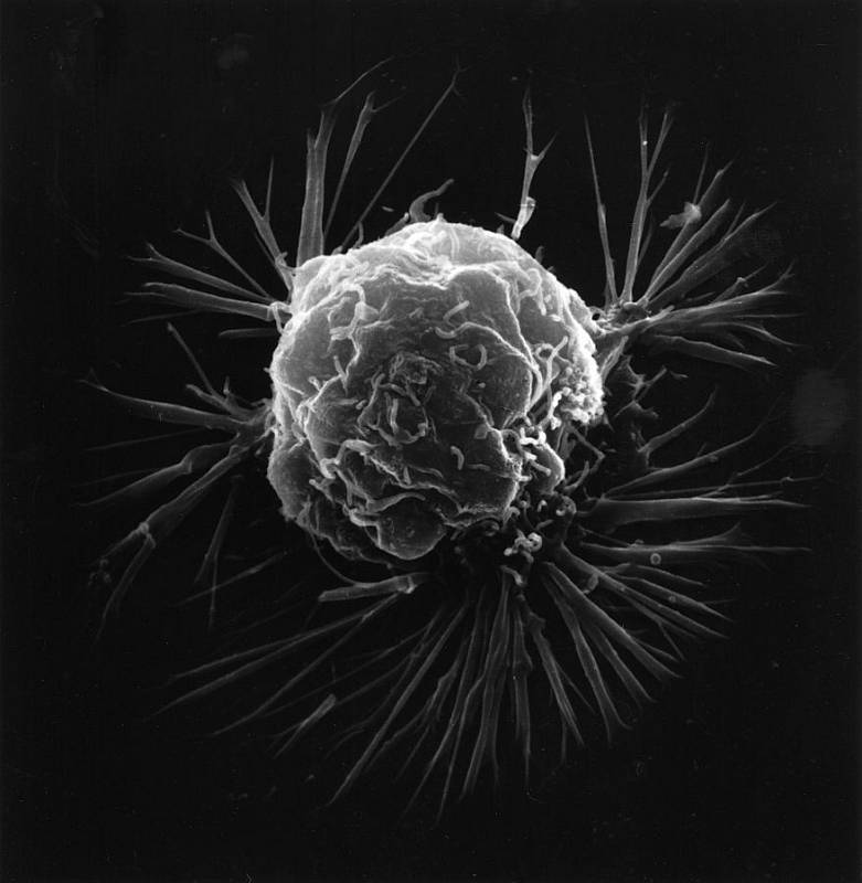 Snímke buňky rakoviny prsu pořízený rastrovacím elektronovým mikroskopem, vytvářejícím trojrozměrné obrazy. Celkový tvar povrchu buňky při vysokém zvětšení