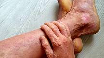 Maruška má kůži postiženou na 80 procentech těla