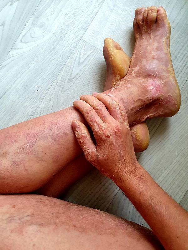 Maruška má kůži postiženou na 80 procentech těla