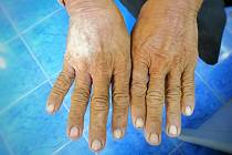 Postižení kůže se zpočátku projevuje zejména na rukou, které otékají, tuhnou a ztlušťuje se na nich kůže. Pokožka působí leskle, je napjatá a tuhá. Na počátku mohou tyto projevy připomínat ranní ztuhlosti při artritidě.