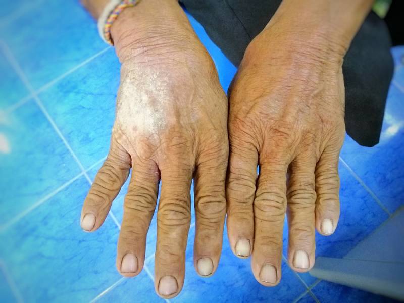 Postižení kůže se zpočátku projevuje zejména na rukou, které otékají, tuhnou a ztlušťuje se na nich kůže. Pokožka působí leskle, je napjatá a tuhá. Na počátku mohou tyto projevy připomínat ranní ztuhlosti při artritidě.