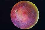 Sítnice diabetika postižená retinopatií