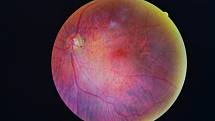 Sítnice diabetika postižená retinopatií