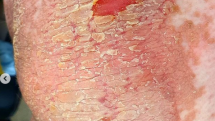 Záněty kůže Maruška řeší pravidelně kortikoidy a antibiotiky