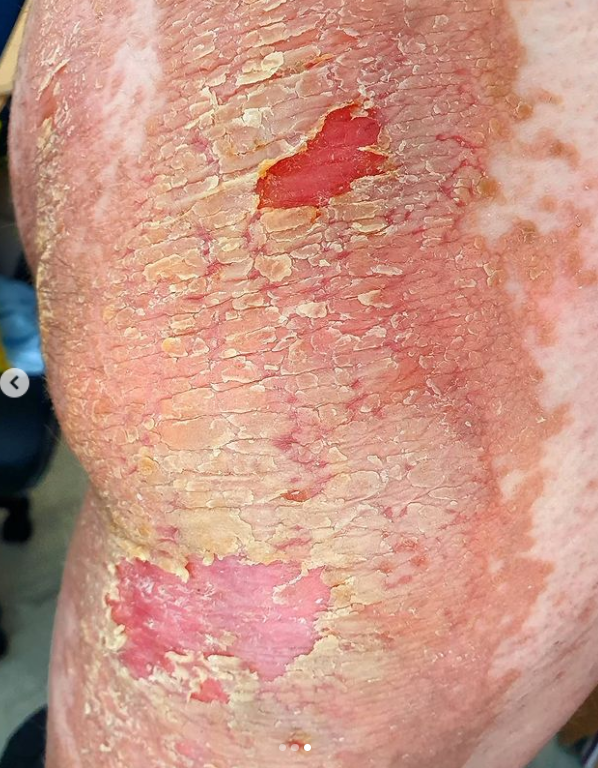 Záněty kůže Maruška řeší pravidelně kortikoidy a antibiotiky