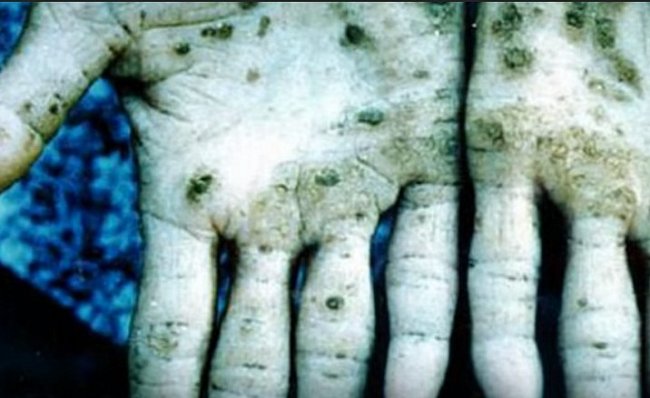 Děsivé stopy arzenu na rukou mumie z Chile