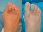 Stav nohy před a po operaci.