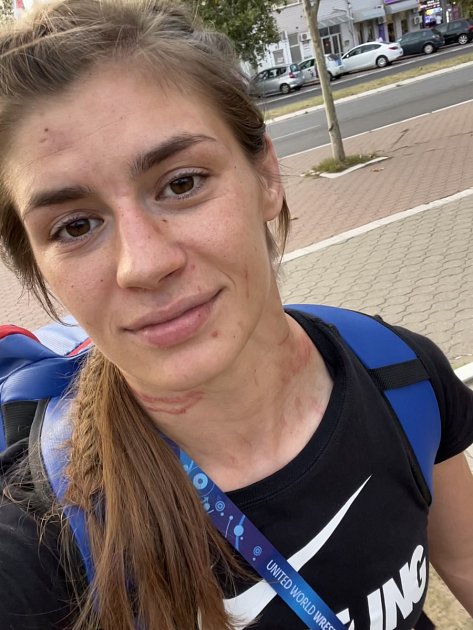 Poškrábaná zápasnice Adéla Hanzlíčková po nefér zápase s tureckou soupeřkou.