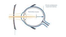 Čočka Miyosmart má unikátní technologii. Brýle s těmito čočkami nejen dobře řeší ostré vidění dítěte, ale poskytují i podpůrnou, posilující rozostřující periferní zónu. Ta pomáhá, aby se krátkozrakost nerozvíjela, a oko nerostlo víc, než tak, jak má v sou