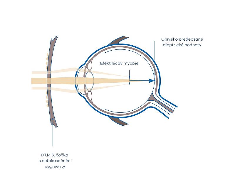 Čočka Miyosmart má unikátní technologii. Brýle s těmito čočkami nejen dobře řeší ostré vidění dítěte, ale poskytují i podpůrnou, posilující rozostřující periferní zónu. Ta pomáhá, aby se krátkozrakost nerozvíjela, a oko nerostlo víc, než tak, jak má v sou
