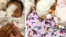Operaci k odstranění oka dívenka podstoupila o osm dní později.