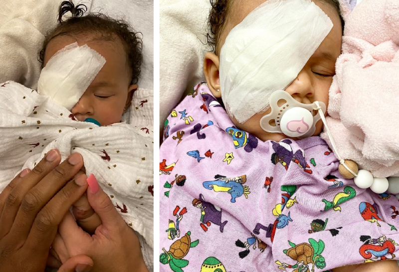 Operaci k odstranění oka dívenka podstoupila o osm dní později.