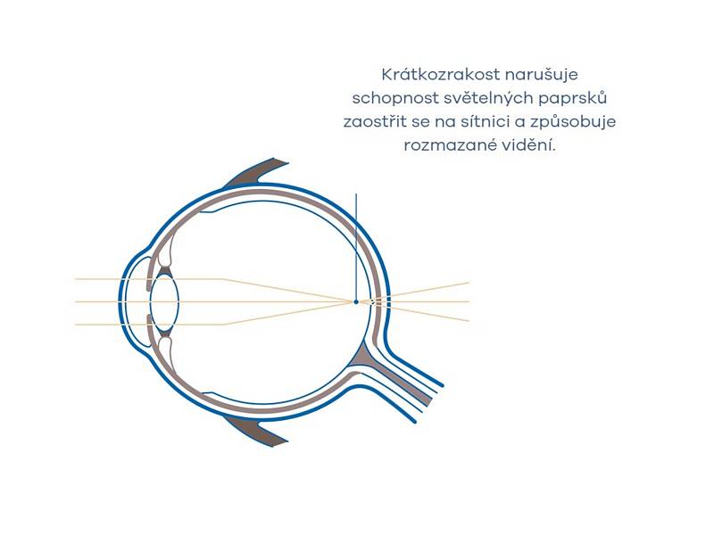 Schéma ukazuje, kam dopadají paprsky v oku při krátkozrakosti.