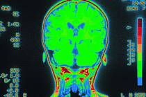 Aktivita mozku při nasazení magnetické rezonance.