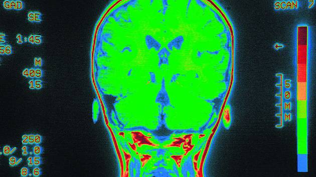 Aktivita mozku při nasazení magnetické rezonance.