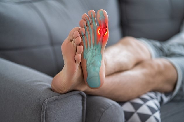 Akutní dnavý záchvat nejčastěji postihuje palec u nohy.