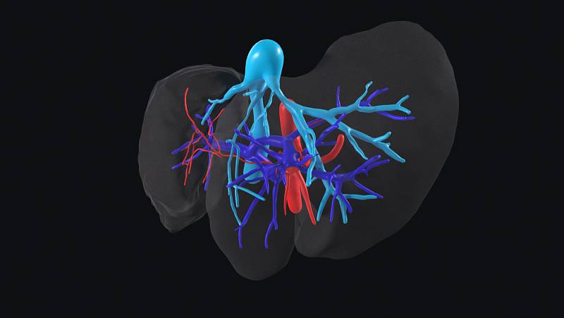 Trojrozměrný model operovaného orgánu tak, jak ho vidí chirurg v brýlích pro virtuální realitu.