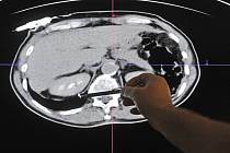 Snímek ledvin. Ilustrační snímek