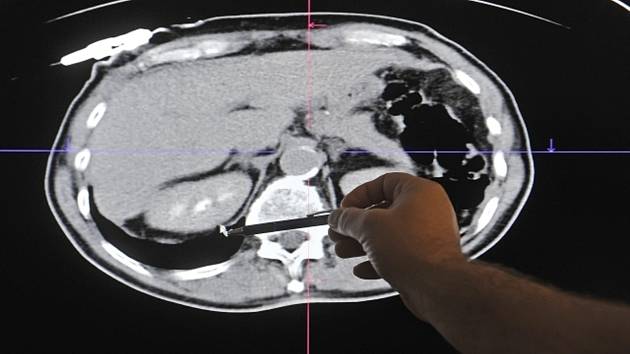 Snímek ledvin. Ilustrační snímek