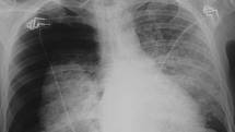 Rentgenový snímek lidských plic napadených pneumocystózou