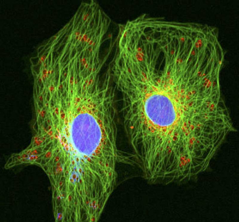 Rakovinné buňky s průměrem okrouhlých jader asi 12 mikrometrů ve speciálním mikroskopu na zkoumání živých buněk. Ilustrační snímek