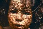 Dívka z Bangladéše, která se v roce 1973 nakazila pravými neštovicemi. O čtyři roky později se podařilo v této zemi nemoc vymýtit