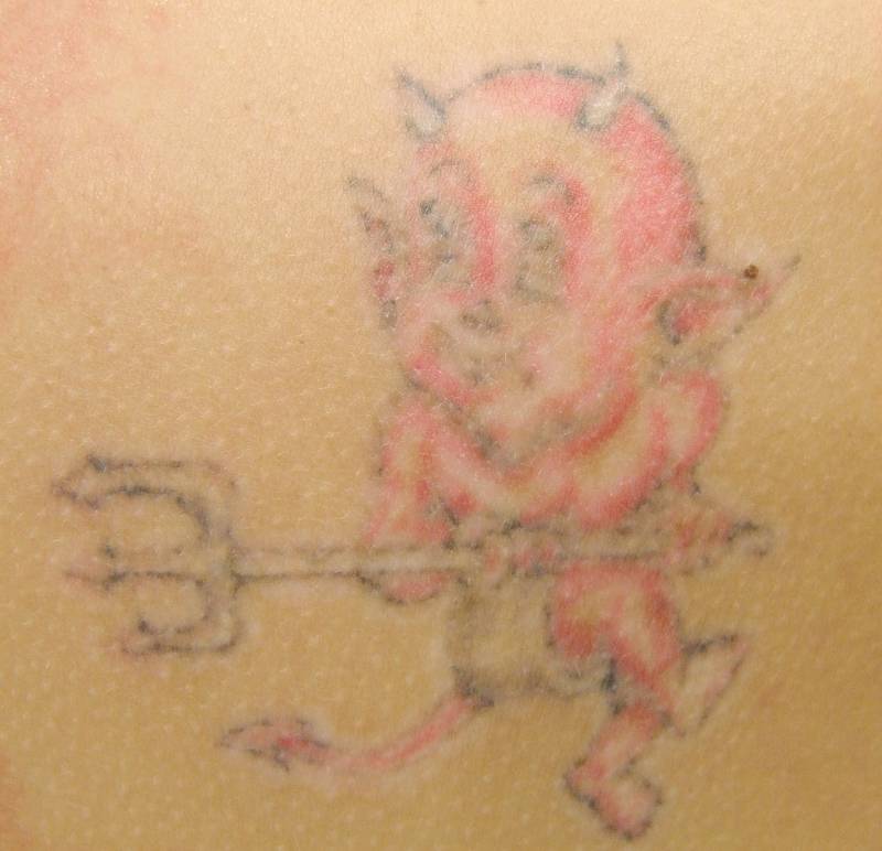 Tetování na rameni během řady ošetření laserem