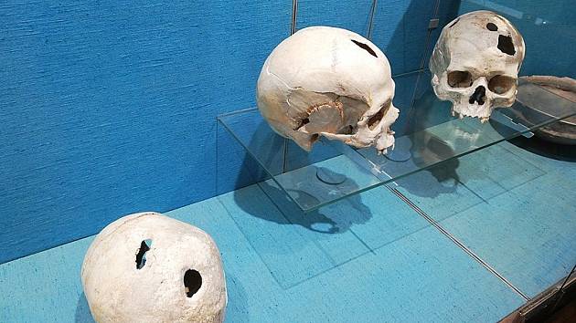 Lebky s dírami po trepanaci. Ostatky pocházejí z doby bronzové, nalezeny byly ve Francii. Ilustrační foto